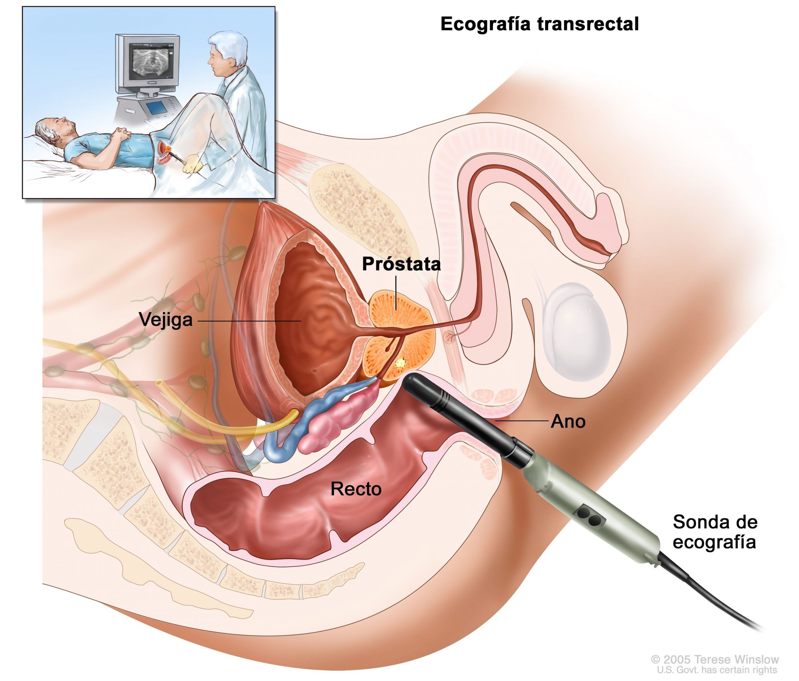 Próstata Transrectal