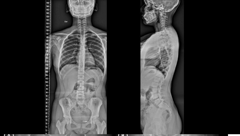 lumbar